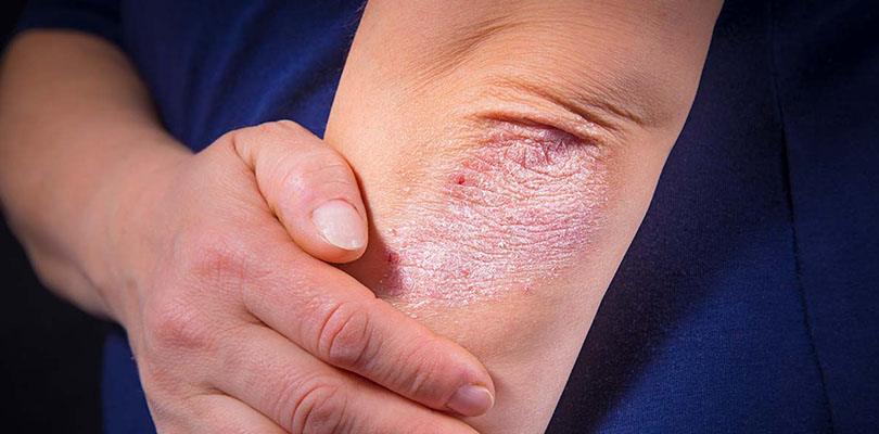 An individual has a rash on their elbow.