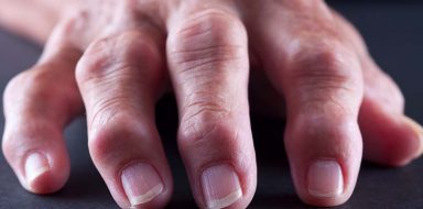 Rheumatoid nodules on a person's hand.