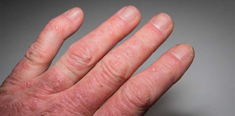 Fingers that are affected my psoriatic arthritis.